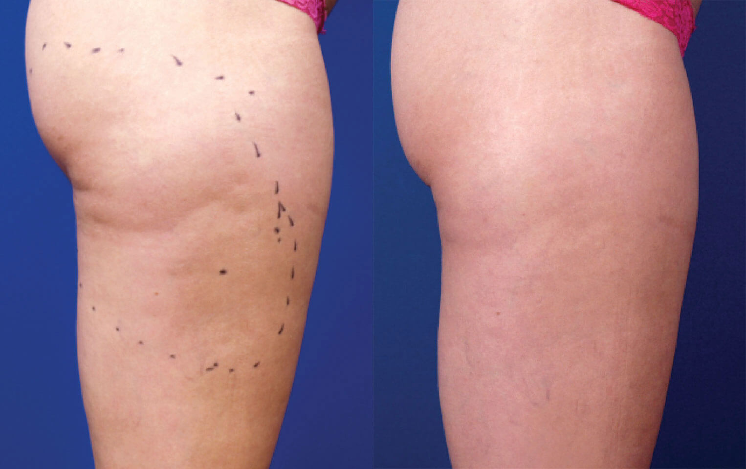 Cellulite Reduction - Before & After Photos - LightRx Face..