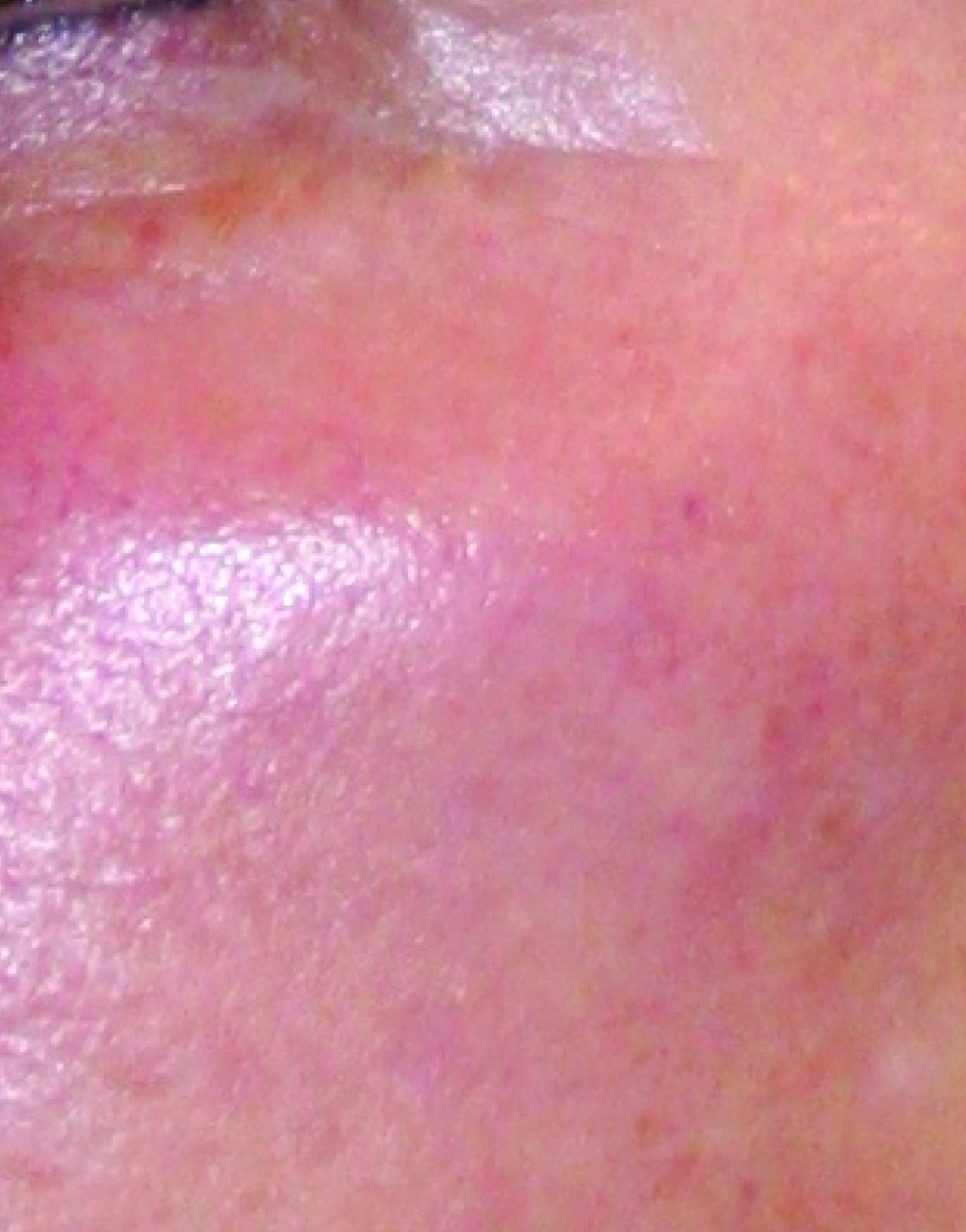 SKIN TIGHTENING LightRx