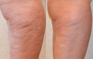 Cellulite Reduction | Before & After | LightRx MedSpa