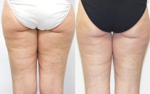 cellulite reduction