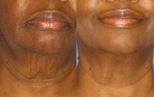 facial skin tightening