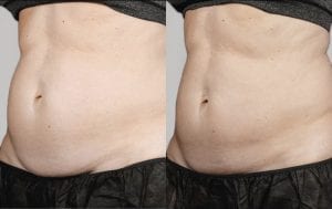 laser lipo