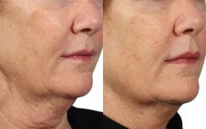 skin rejuvenation