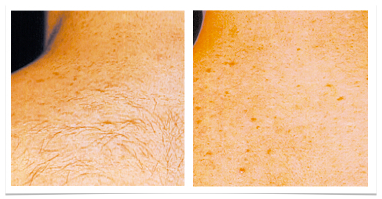 Stimulate hair growth with laser rejuvenation - The Clifford Clinic
