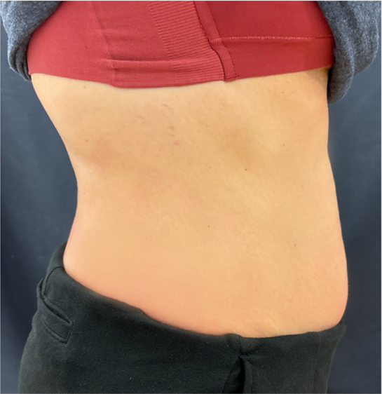 mebership glp2 after